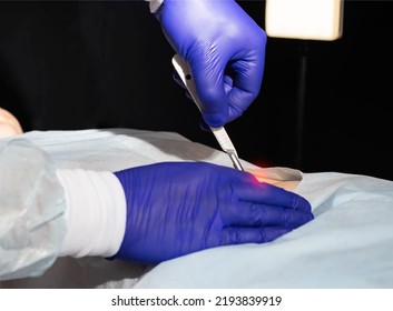 Doctor's Hands In Medical Gloves With A Scalpel In His Hands. The Concept Of A Surgical Operation To Remove An Umbilical Hernia Of The Abdominal Wall, Close-up, Instruments