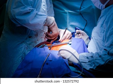 Doctors Operating On Patient, Performing Cardiac Surgery