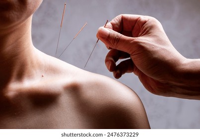 Doctors perform acupuncture and moxibustion treatment for women's shoulders - Powered by Shutterstock