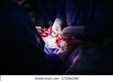 Doctors Performing A Caesarian Section In An Operating Theater In A Hospital