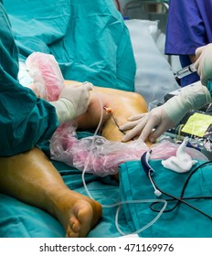 Doctor's Surgery Foot Suture,leg ,medical Devices,Percutaneous Transluminal Angioplasty ,Vascular Bypass Graft Surgery