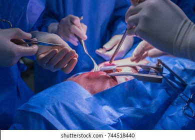 Doctors Team Wear Blue Coat Perform Heart Surgery At The Operating Room In The Hospital.