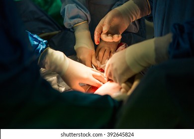 Doctors Working On The Wound Of A Mother That Just Gave Child Birth Via A Caesarean Section.