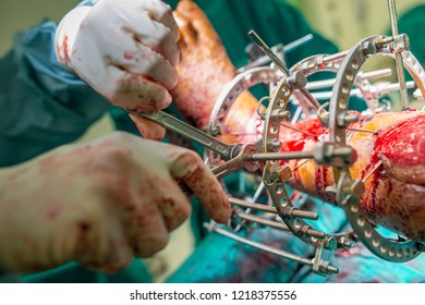 Doctor/surgeon Tightening Screw While Perform Ring External Fixator Was Apply In Case Of Open Comminuted Fracture Tibia With Severe Soft Tissue Damage