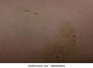 Dog Bite Mark On Skin