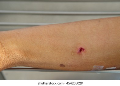 Puncture Wounds Images Stock Photos Vectors Shutterstock