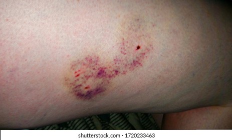 2,090 Human bite wound Images, Stock Photos & Vectors | Shutterstock