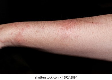 6,275 Bite Wound Images, Stock Photos & Vectors 