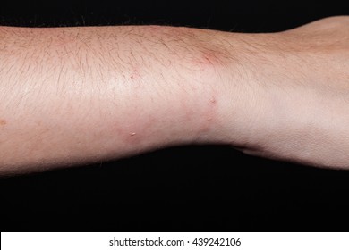 Case Hypertrophic Verrucous Lichen Planus On Stock Photo 1337416046 ...