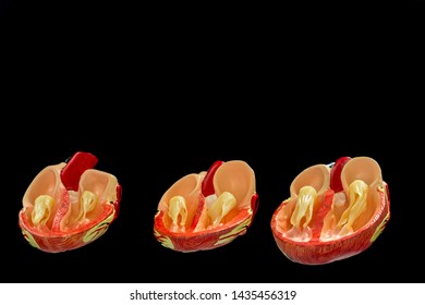 what is canine dilated cardiomyopathy dcm in dogs