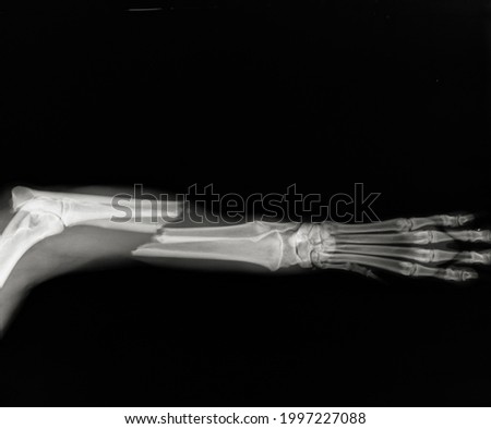 Dog leg fracture xray. Canine radius and ulna limb fracture radiograph 