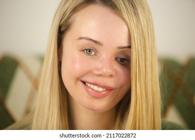 Domestic Violence Victim Living Happy Life. Beautiful Blonde Woman With Face Scars And Prosthetic Eye Looking In Camera With Cheerful Toothy Smile. Injured Abuse Survivor Being Positive And Friendly