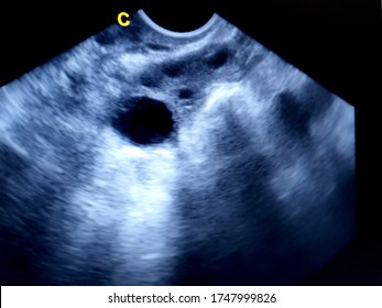 dominant follicle in ovary by ultrasound - Shutterstock ID 1747999826