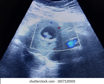 230 Fetal heart doppler Images, Stock Photos & Vectors | Shutterstock