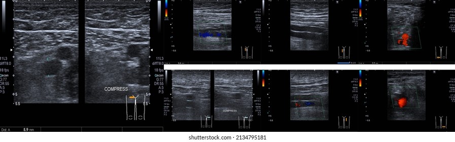 Doppler Ultrasound Of Deep Vein Thrombosis Superficial Femoral Vein Compresses Legs Medical Healthcare Concept. Content Contains Chrominance Noise, Luminance Noise, Sharpening Noise, Or Film Grain 