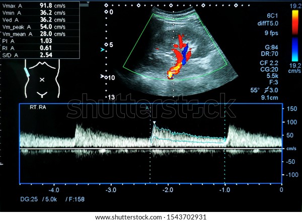 renal artery doppler ultrasound renal artery doppler ultrasound