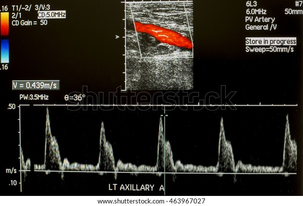 Doppler Ultrasound Left Axillary Artery Wave Stock Photo (Edit Now ...