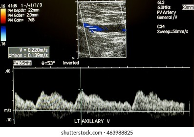 Doppler Ultrasound Left Axillary Vein With Wave