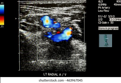 Doppler Ultrasound Left Radial Artery And Vein