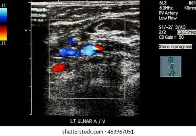 Doppler Ultrasound Left Ulnar Artery And Vein