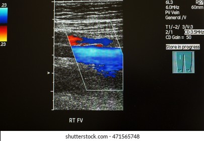 doppler ultrasound legs
