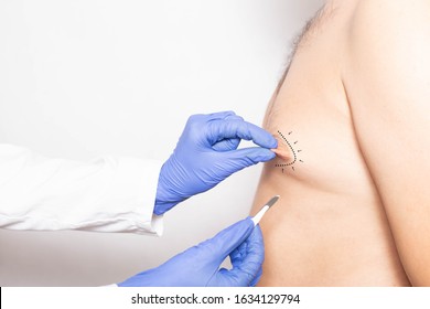 Dotkor plastic surgeon examines the nipples in the male patient for surgery to correct and change the shape of the nipple, anaplasty