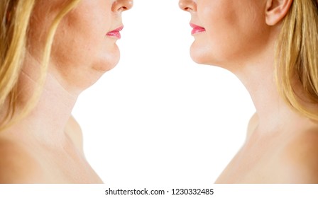 Double chin fat or dewlap correction, before and after