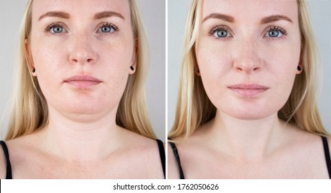 Double chin lift in women. Photos before and after plastic surgery, mentoplasty or facebuilding. Chin fat removal and face contour correction