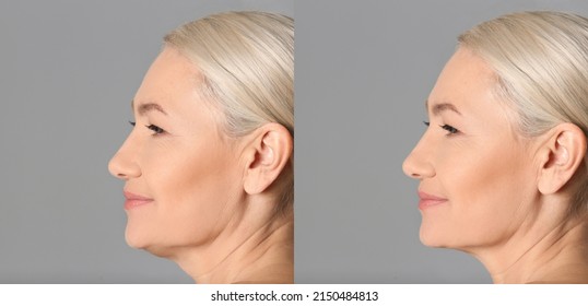 Double Chin Problem. Collage With Photos Of Mature Woman Before And After Plastic Surgery Procedure On Grey Background, Banner Design