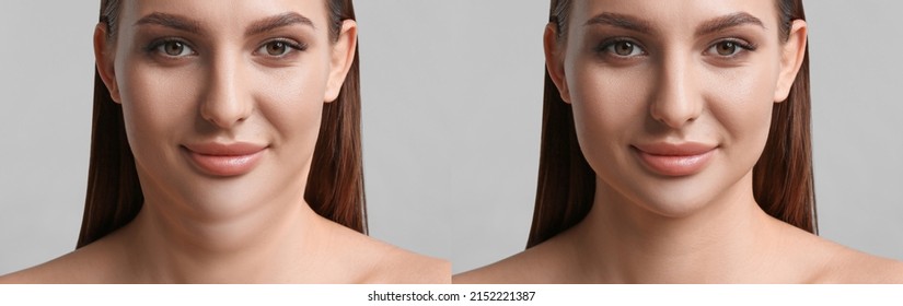 Double Chin Problem. Collage With Photos Of Young Woman Before And After Plastic Surgery Procedure On Light Grey Background, Banner Design