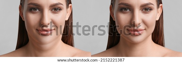 Double chin problem. Collage with photos of young\
woman before and after plastic surgery procedure on light grey\
background, banner\
design