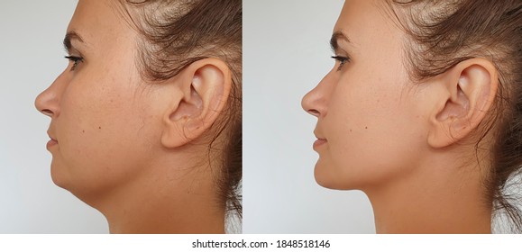 Double chin in women before and after treatment