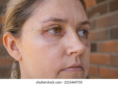 Double Eyelid Surgery, Eyes Surgery Recover Period, Immediately 