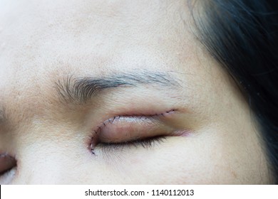 Double Eyelid Surgery Selective Focus.