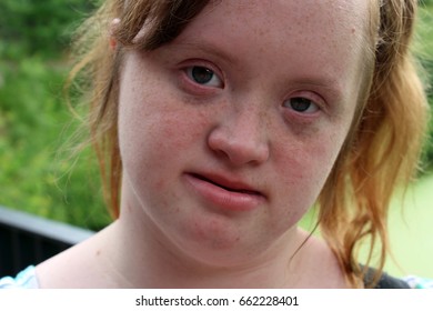 Down Syndrome - Young Woman With Down Syndrome