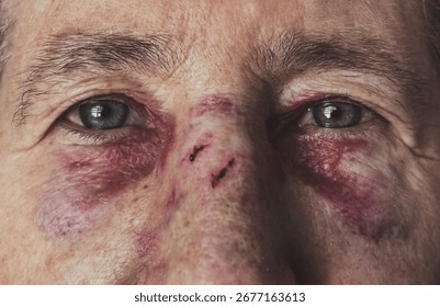 Dramatic Close-Up of a Woman's Face with Severe Bruising and Injuries