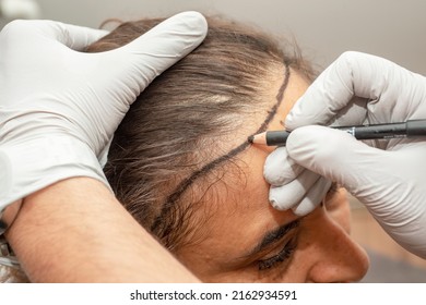 Drawing for hair transplant for woman with sparse hair - Shutterstock ID 2162934591