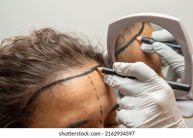 Drawing for hair transplant for woman with sparse hair - Shutterstock ID 2162934597