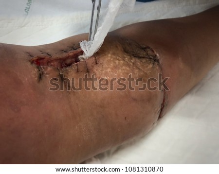Dressing wound with infected false aneurysm left arm. Medical and healthcare concept.