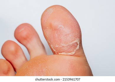 Dried Skin On Big Toe Stock Photo 2153961707 | Shutterstock