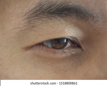 drooping eyelid or ptosis and dry eye in asian man cause of muscles lifting the eyelid treatment by surgery use for health care concept.