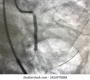 Drug Eluting Stent (DES) Deployed At Left Circumflex Artery (LCx).