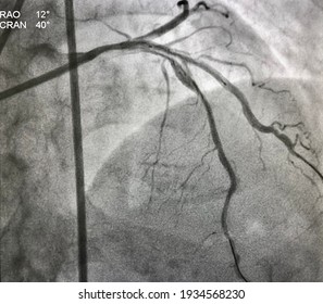 Drug Eluting Stent (DES) Deployed At Left Anterior Descending Artery (LAD) To Diagonal Branch (DG). Coronary Bifurcation Percutaneous Coronary Intervention.