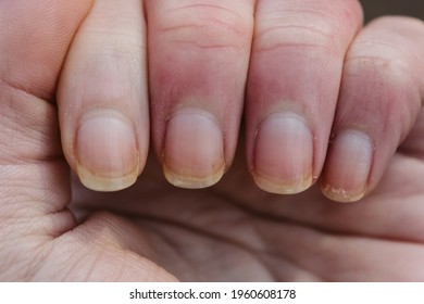 Dry Brittle Nails. Chipped Yellow Nails.