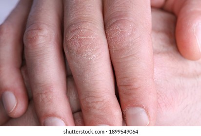 Dry, Chapped And Cracked Male Hands Close Up, Winter Skin Care Concept