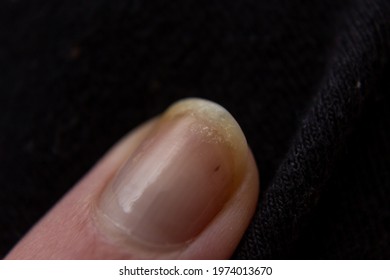 Dry And Chipped Nail, Isolated On Black Background.