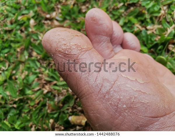 toe dry cracked skin
