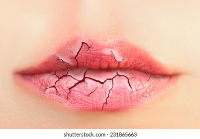 Dry, Cracked Lips. 