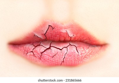 Dry, Cracked Lips. 