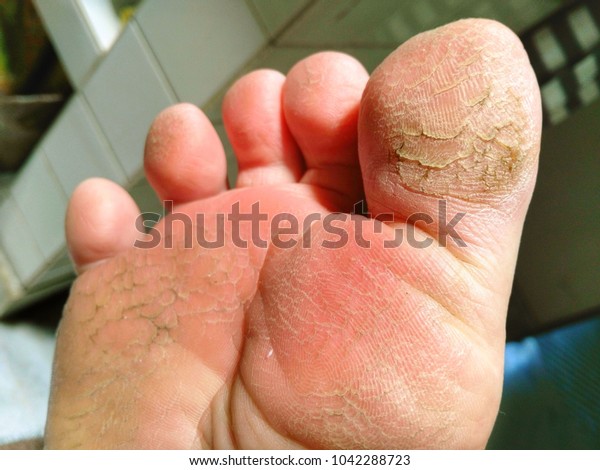 toes dry and peeling